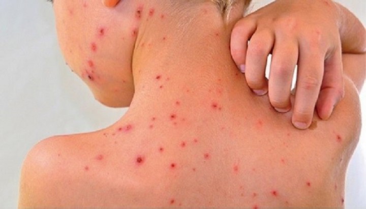 Measles in Chile: how we avoid it and what are the symptoms